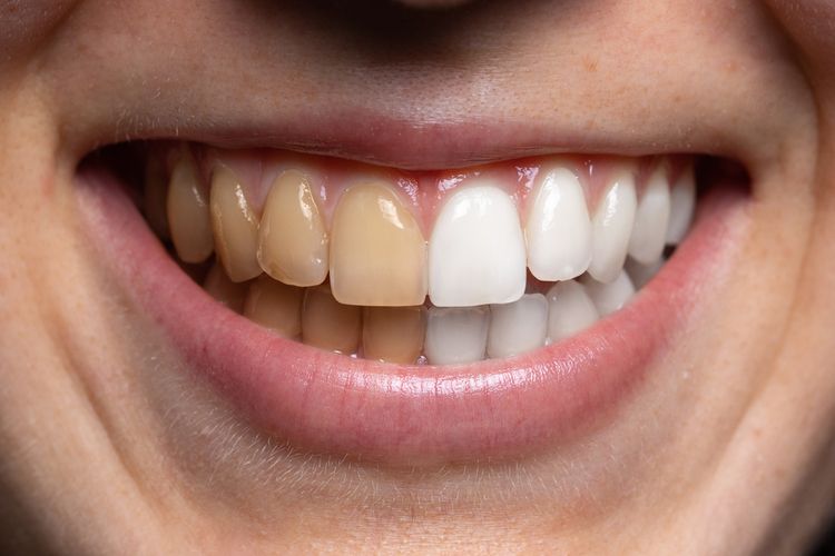 Inilah 6 Cara Memutihkan Gigi dengan Bahan Alami
